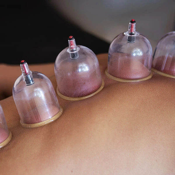 Woman receiving myofascial decompression cupping therapy on back along spine