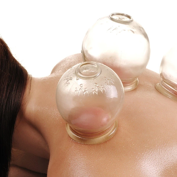 Woman receiving myofascial decompression cupping therapy on upper back