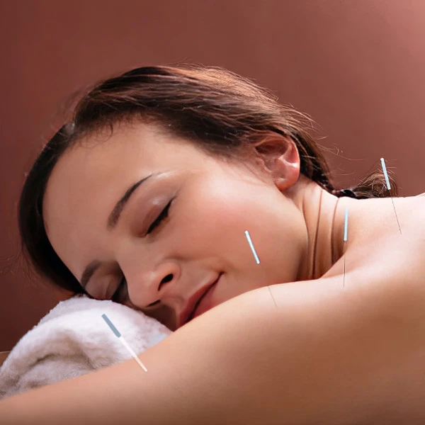 Woman receiving acupuncture therapy shoulders and neck