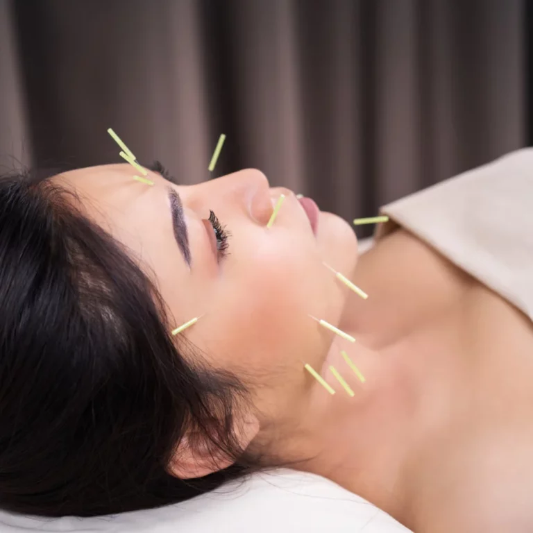 Woman receiving cosmetic acupuncture therapy on face