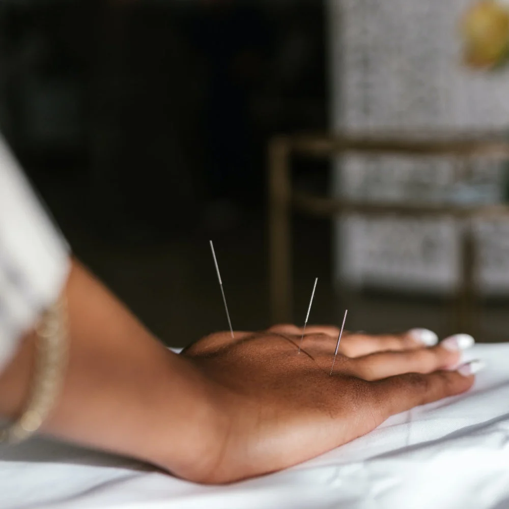 Woman receiving acupuncture therapy on back of hand