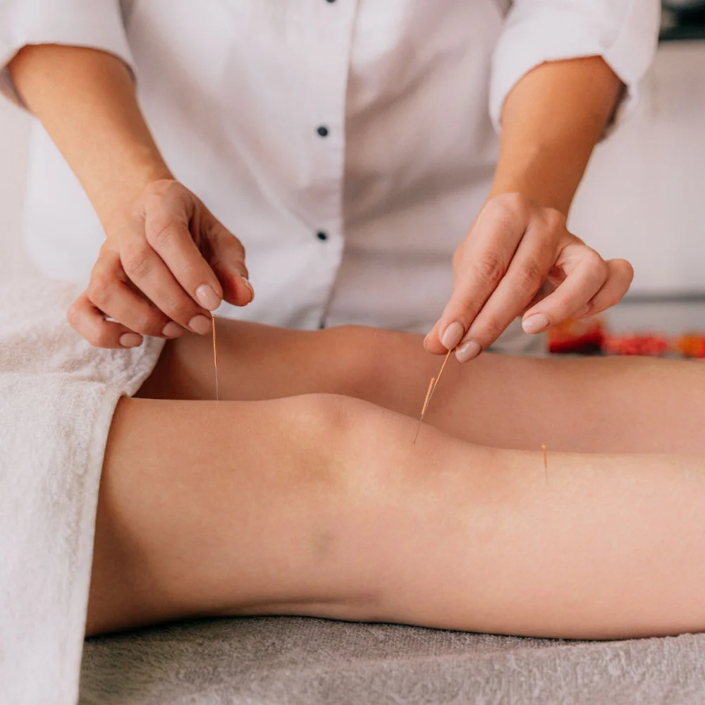 Woman receiving acupuncture therapy around knee and leg area