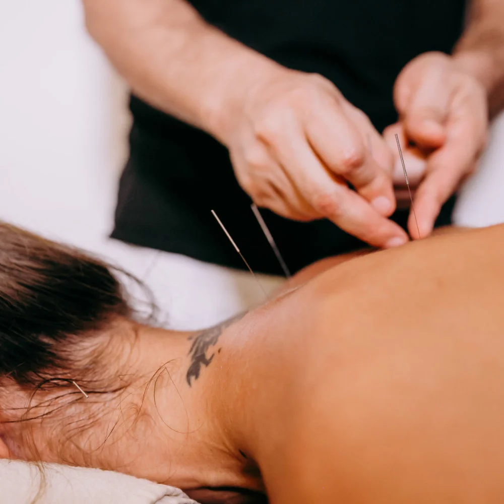 Woman receiving acupuncture therapy for upper back
